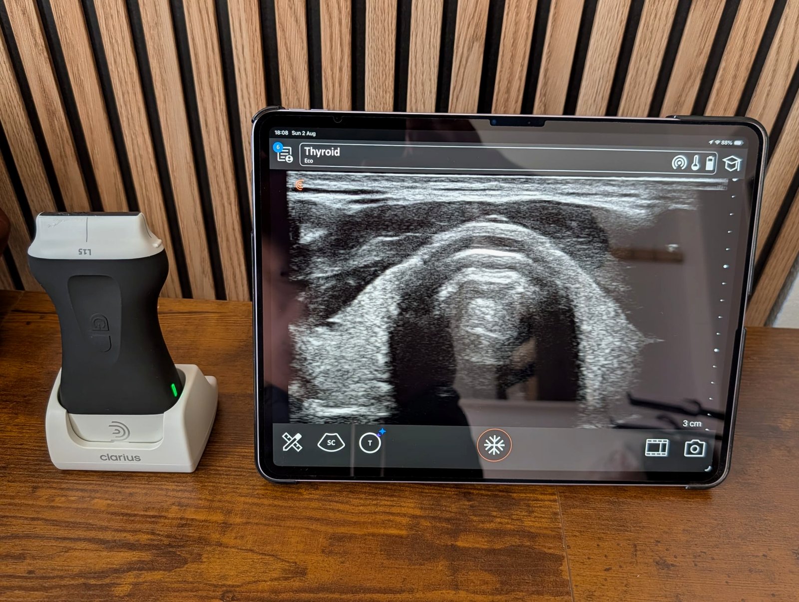 Ultrasound probe and tablet showing a thyroid scan