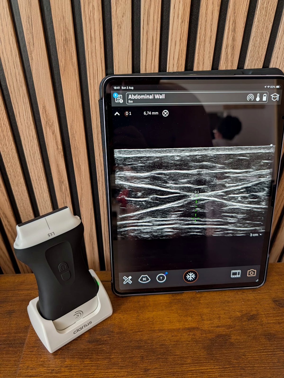 Ultrasound probe and tablet showing an abdominal wall scan with a measurement on screen